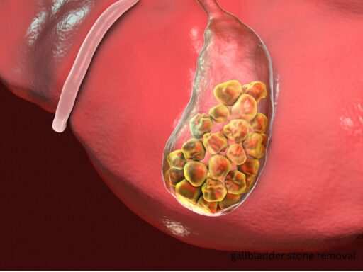 Gallbladder Stone Removal: Treatment and Recovery Guide